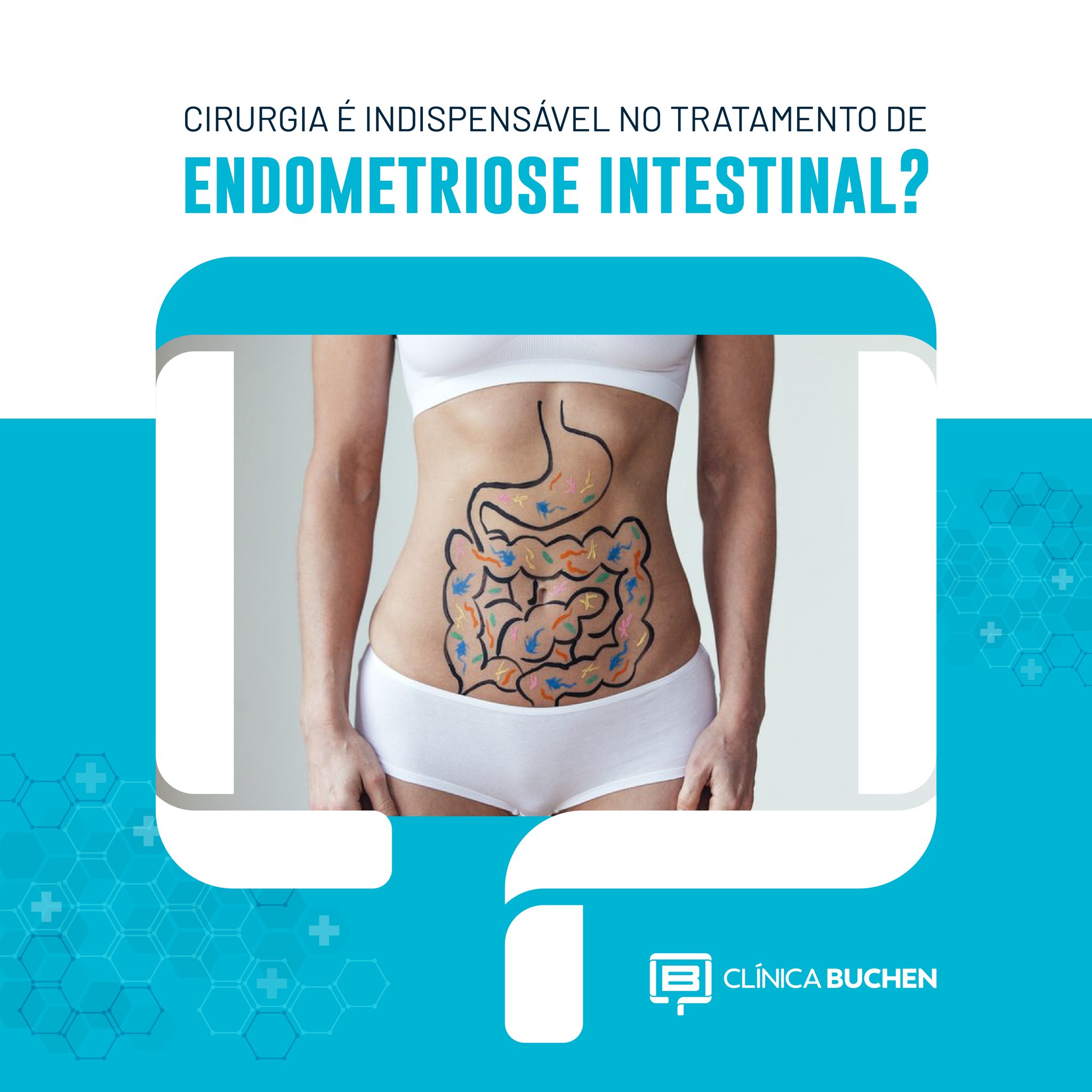 Cirurgia  indispensvel no tratamento da endometriose intestinal?