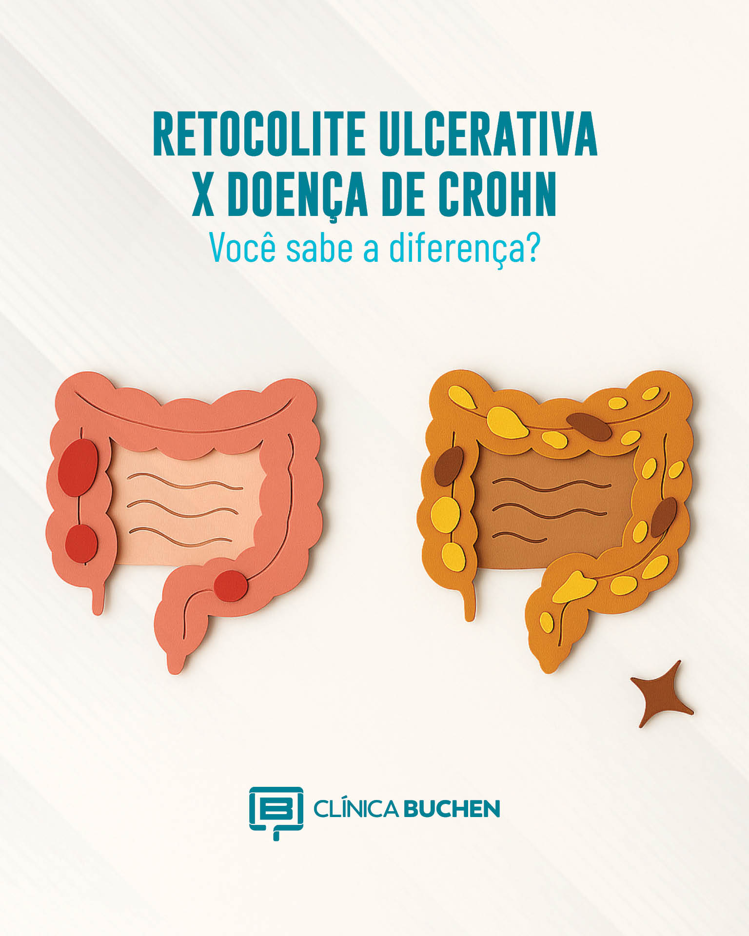 Retocolite Ulcerativa x Doen�a de Crohn: entenda as diferen�as
