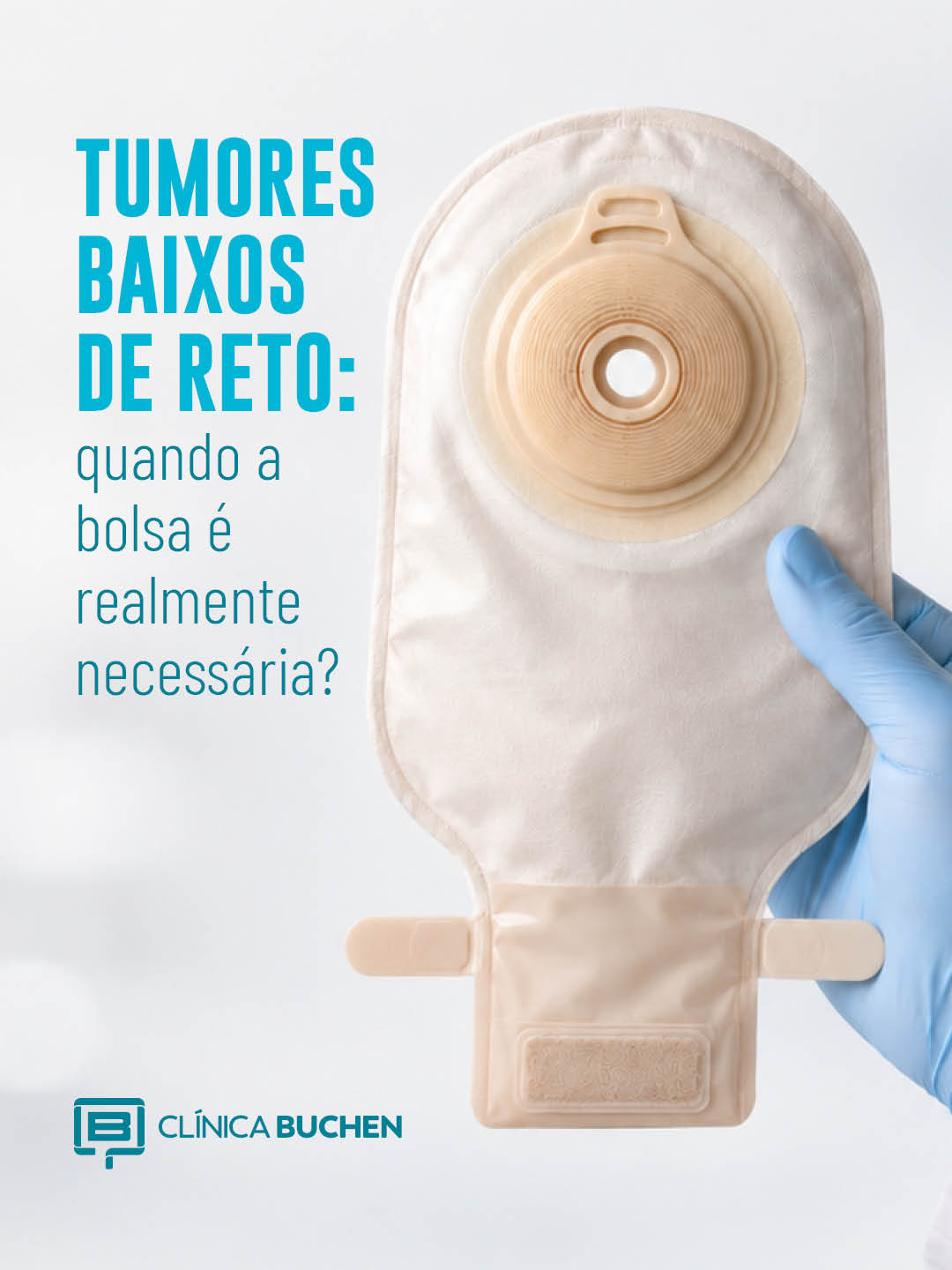  Tumores baixos de reto: quando a bolsa � realmente necess�ria?